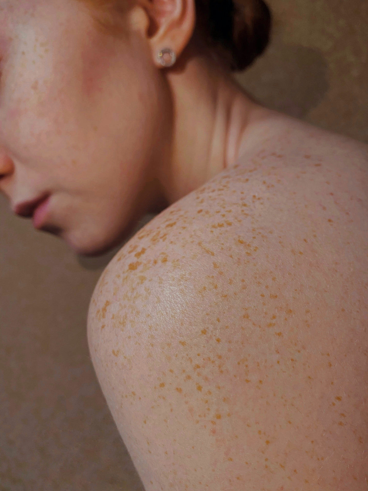 Hyperpigmentation & Dark Spots